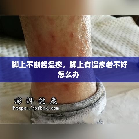 腳上不斷起濕疹，腳上有濕疹老不好怎么辦 