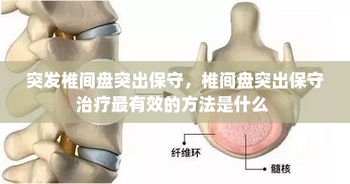 突發(fā)椎間盤(pán)突出保守，椎間盤(pán)突出保守治療最有效的方法是什么 